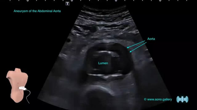 Aneurysm of the Abdominal Aorta