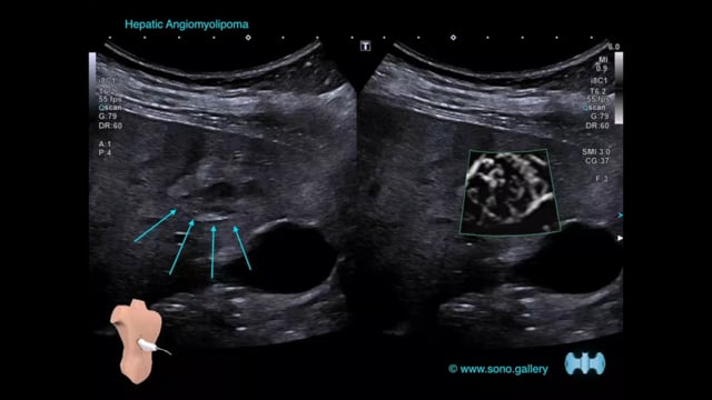 Liver Angiomyolipoma