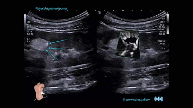 Renal Angiomyolipoma