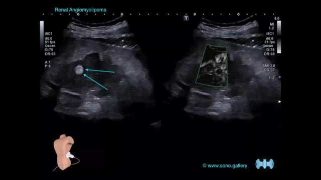 Renal Angiomyolipoma