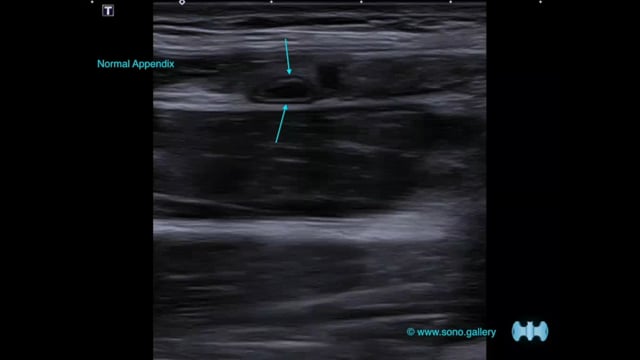 Normal Appendix