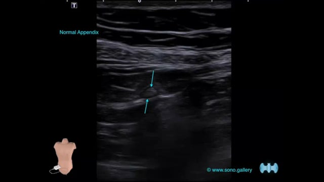 Normal Appendix