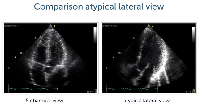 How to obtain the lateral view of the left ventricle