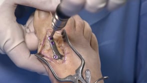 Première arthrodèse de l’articulation métatarso-phalangienne avec plaque d’arthrodèse Airlock® MTP et vis de compression Nexis®.