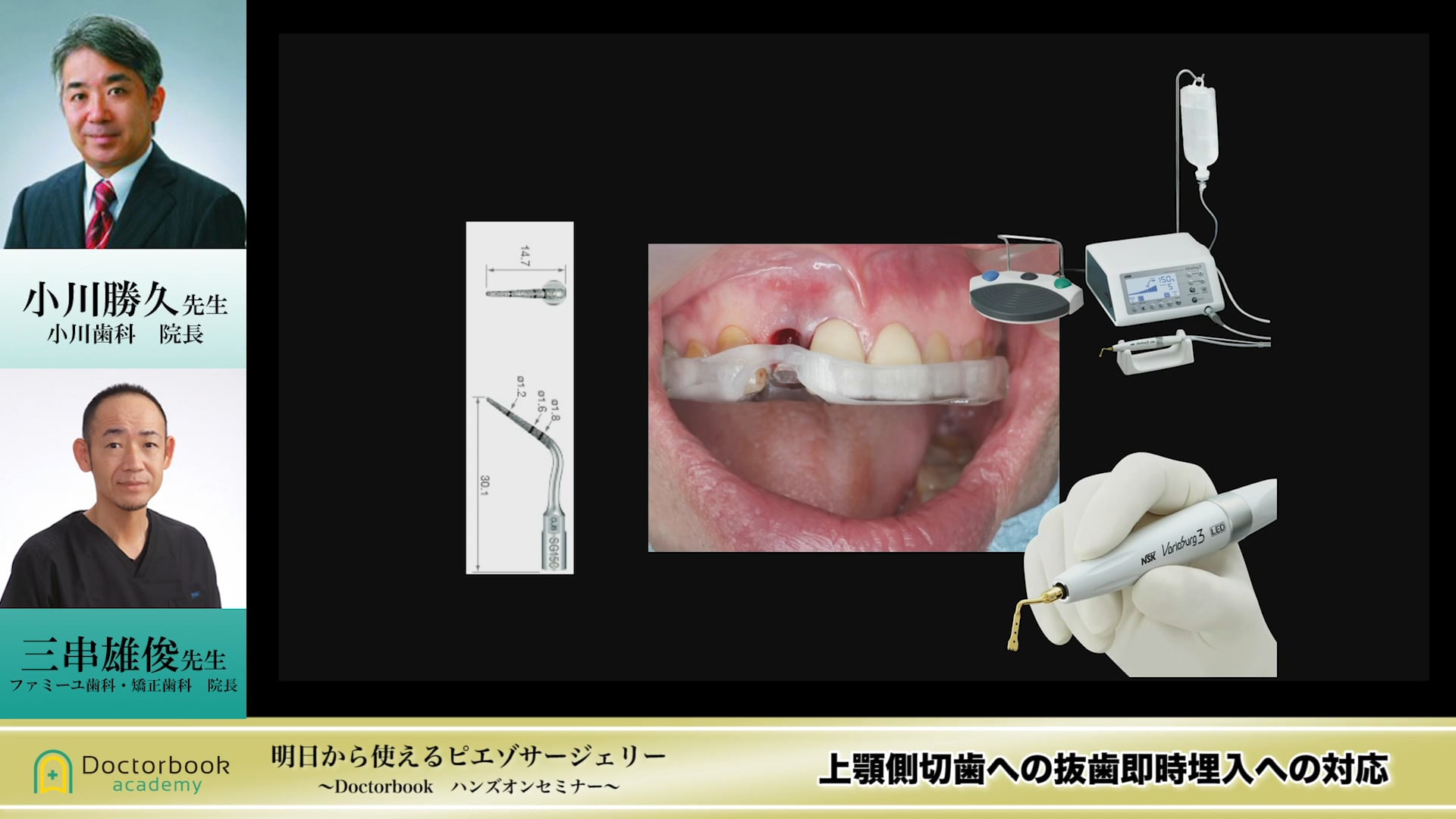 上顎側切歯への抜歯即時埋入への対応 #2