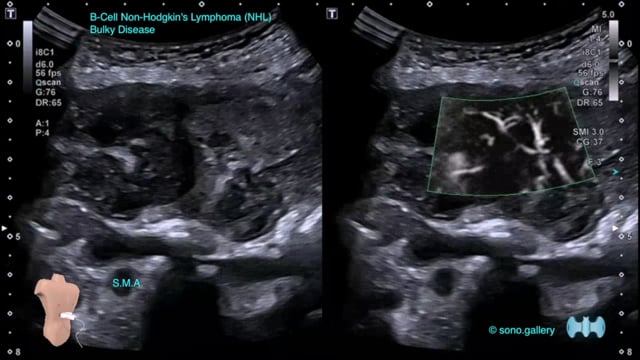B-Cell Non-Hodgkin’s Lymphoma (NHL) Bulky Disease