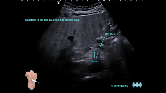 Gallstone in the Bile Duct (Choledocholithiasis)