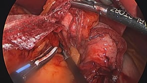 Laparoscopic Roux En Y Gastric Bypass – Antecolic Transoral GJ with a Triple Staple J-J Technique