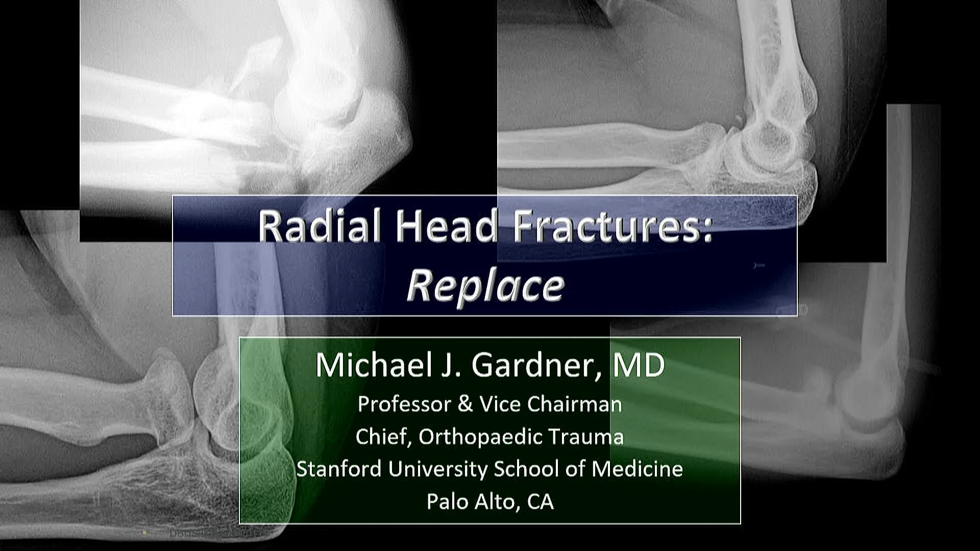 Fractures 第四版 Michael J. Gardner Master Techniques in Orthopaedic Surgery: Fractures