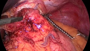 Laparoscopic Magnetic Lower Esophageal Augmentation (LINX)