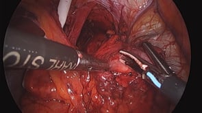 Laparoscopic Heller Myotomy with Toupet Fundoplication