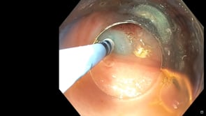Endoscopic Submucosal Dissection (ESD) & Resection