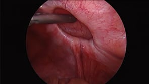 Laparoscopic Spigelian Hernia Repair