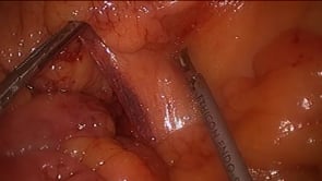 Laparoscopic Proctocolectomy