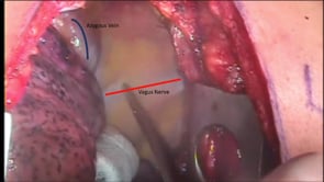 Open McKeown 3-Hole Total Esophagectomy