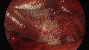 Laparoscopic TEP Inguinal Hernia Repair