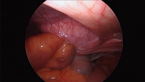 Laparoscopic Ventral Hernia Repair with Mesh
