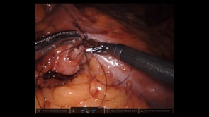 Robotic Right Colectomy