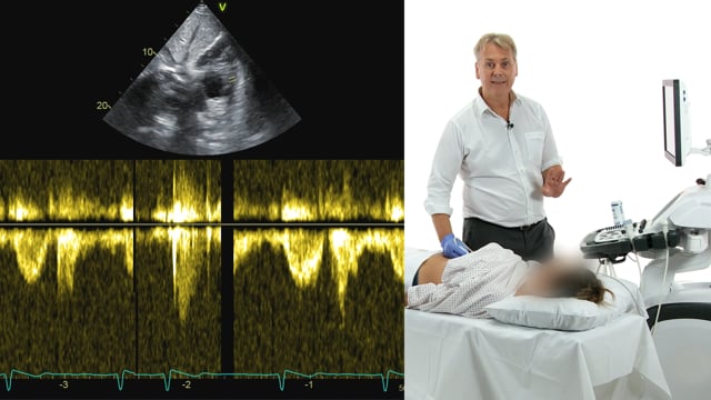 How should I assess a short axis view in the subcostal window?