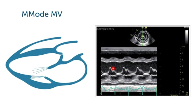 How can I assess the Mitral valve using M-Mode?