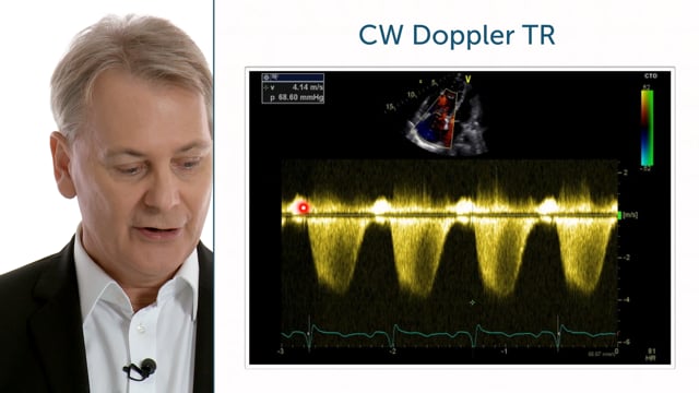 How can I assess the tricuspid valve using Doppler US?