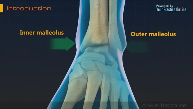 Ankle Fracture Surgery Video, Ankle Sprain