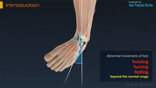 Optimizing Ankle Sprain Recovery for Athletes: ankle sprain