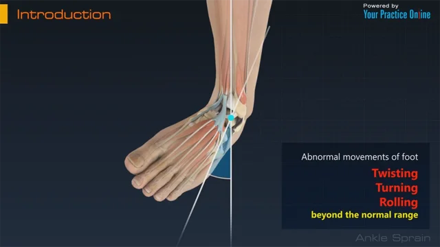 grade 1 ankle sprain swelling