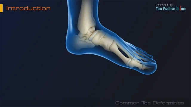 Hammer toe - Sussex Foot And Ankle Clinic