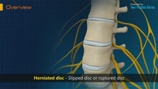 Lumbar Spine Degenerative Disc Diseases Treatment NJ & NYC