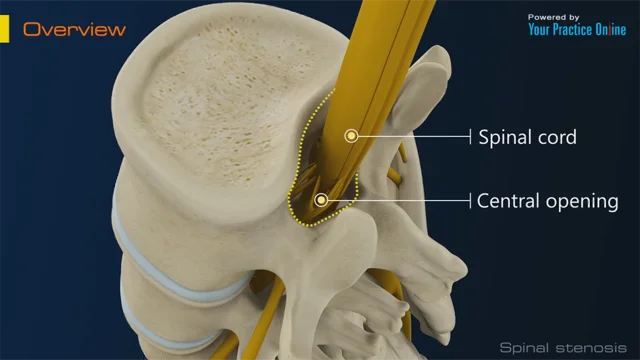 Lumbar Spinal Stenosis  Columbia Orthopaedic Group