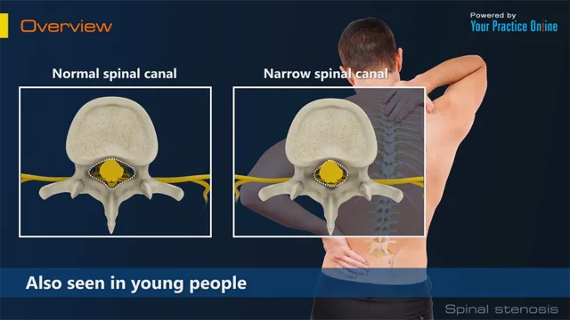 Spinal Stenosis: Treatment in Fairfax, VA  SAPNA: Spine and Pain Clinic of  North America