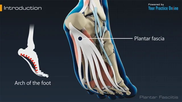 Plantar Fasciitis Treatment Los Angeles