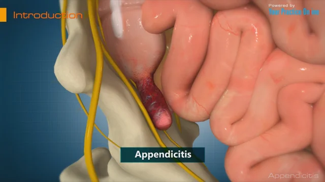 appendix operation