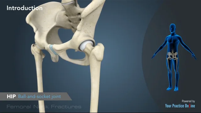 femur fracture anatomy