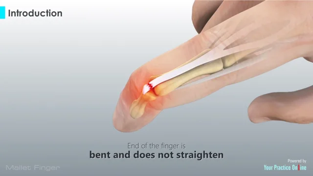 Do I have a mallet finger and what should I do next? - The Rehab Centre