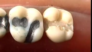 Smoking Teeth – Toxic Fillings