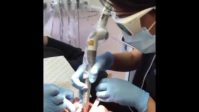 Nightlase Treatment for Sleep Apnea