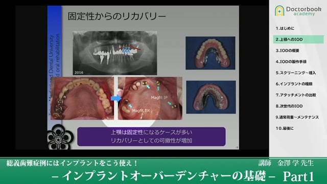 総義歯難症例にはインプラントをこう使え！‐インプラントオーバーデンチャーの基礎‐ | Doctorbook academy (ドクターブックアカデミー)