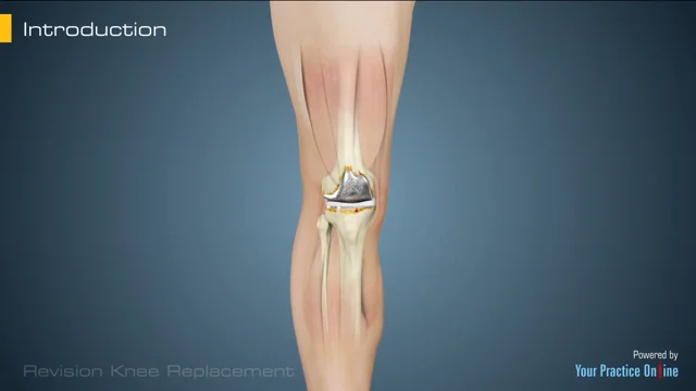 Revision Knee Replacement