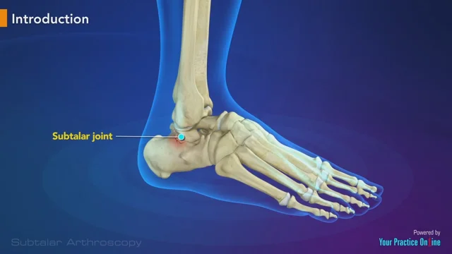 Subtalar Arthroereisis