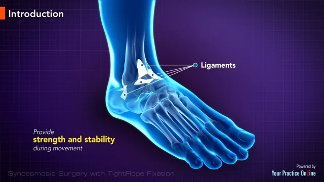TightRope™ Fixation for Ankle Syndesmosis - Houston, TX: Spring