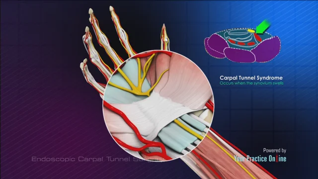 Carpal Tunnel Syndrome Indianapolis  Carpal Tunnel Release Surgery Carmel