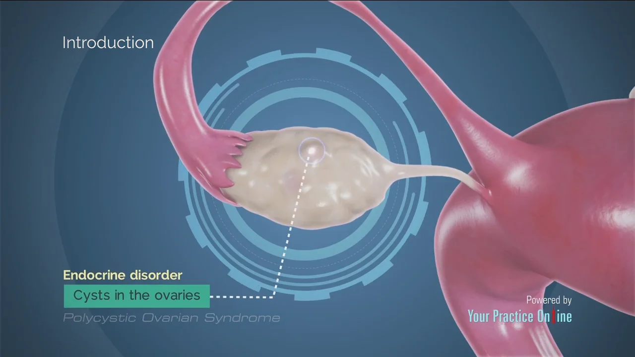 Polycystic Ovarian Syndrome