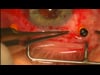 IOL Exchange and Suture Plavix Pt