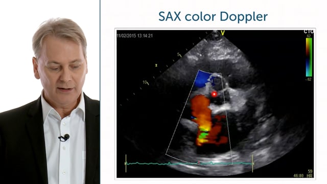 How can I use color Doppler at the base of the heart?