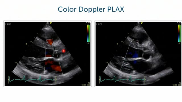 What can I find when I use color Doppler in a PLAX?