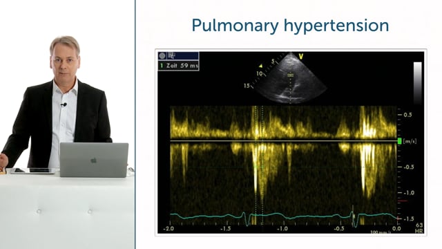 What is pulsed wave Doppler (spectral Doppler)?