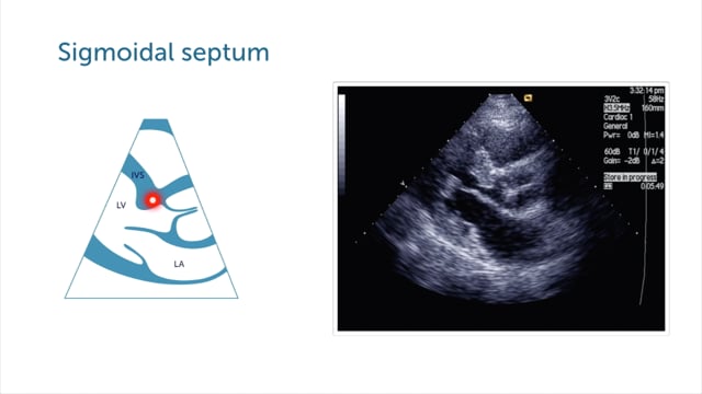 What is a sigmoidal septum?