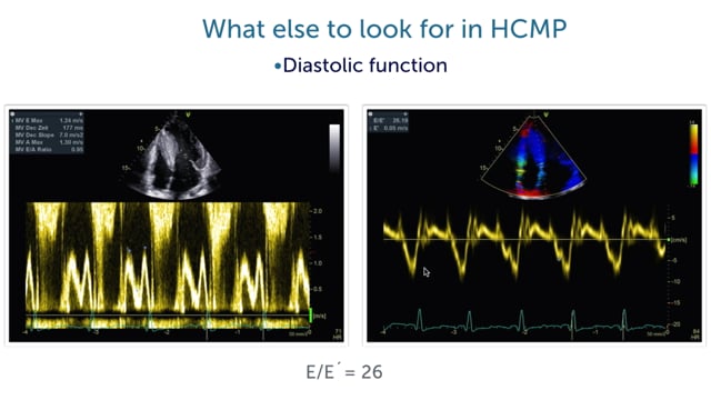 How important is diastolic function in patients with HCMP?